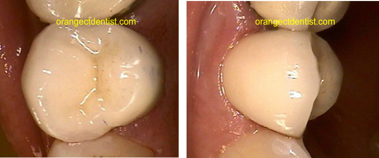 Photos of the same teeth with crowns on them for the patient from West Haven, CT