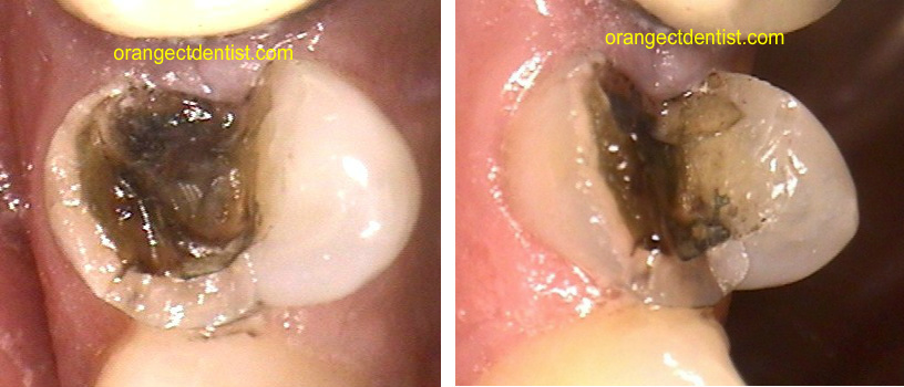 Photos of a broken tooth before a crown was placed in our Orange, CT office serving Woodbridge