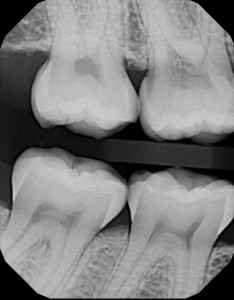 Digital X-ray showing teeth with resorption and cavities from dentists in Orange and Woodbridge, CT