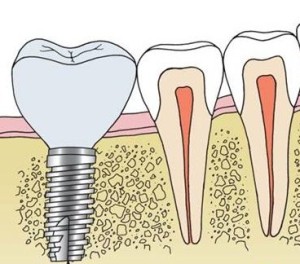Dental Implant Diagram showing missing teeth replacement treatment in Orange, CT