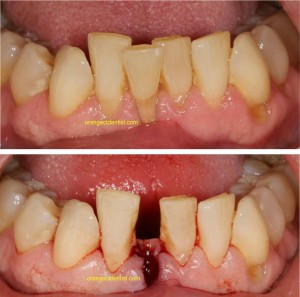 Photo and Picture of Tooth extraction for Invisalign in Orange, CT also seing Woodbridge, West Haven, Milford