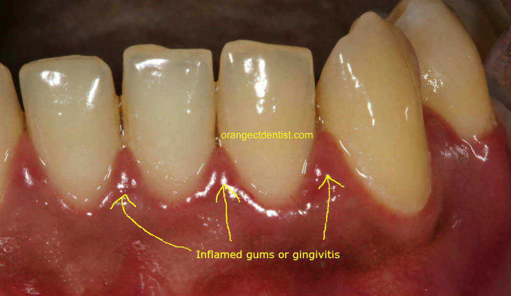 Photo or Picture of inflamed gums or gingivitis on patients at dentist office West Haven and New Haven CT