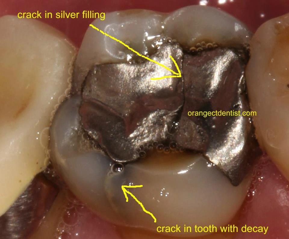 Photo of molar tooth with cracks that needs a crown to be done in Woodbridge, CT