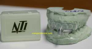 NTI nightguard appliance for stressed Connecticut bruxers