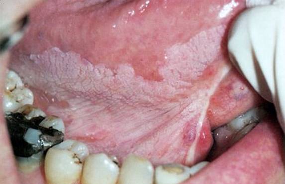 Oral Cancer on lateral tongue detected by dentists doing oral cancer screening