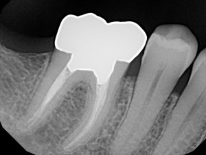 Root canal dental x-ray showing tooth treated in our dentist office in Orange, CT
