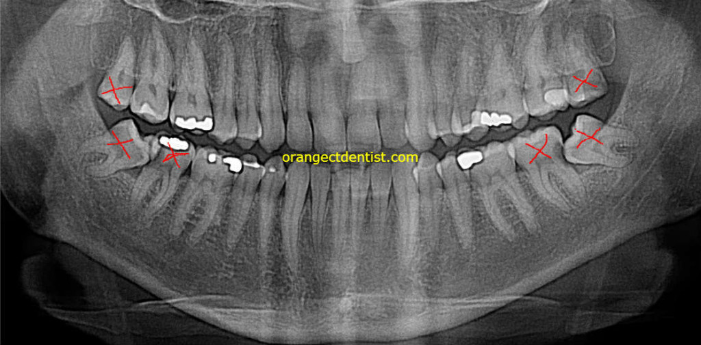 Dental X-ray of wisdom teeth in which the patient got cavities on the adjacent teeth and needed those pulled too in our Orange, CT dentist office