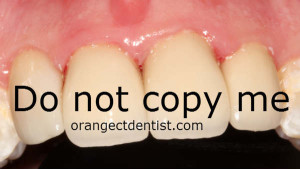 Photo of teeth with do not copy watermark