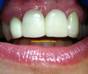 Ugly dental crowns on front teeth - everything you should not do