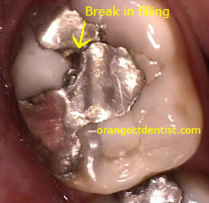 Broke mercury amalgam filling in a tooth which needs a dental crown