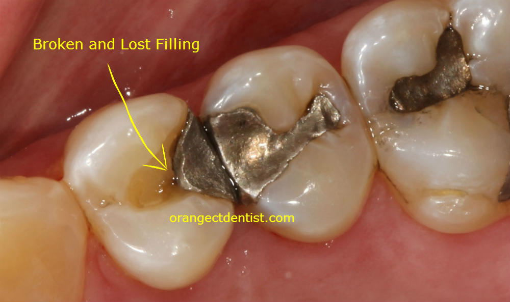 Photo of a lost and broken filling observed that needs a new filling
