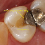 Broken filling dental emergency for Milford, CT and Derby, CT patients