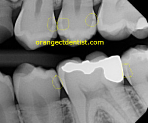 Dental x-ray showing decay or cavities between the teeth