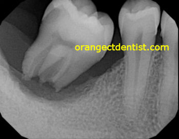 X-ray or radiograph of dental abscess with tooth on Milford, CT patient but helpful to Ansonia, CT people