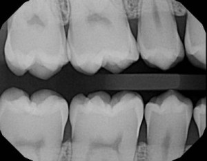 Extraoral bitewing dental x-rays we can take without causing you to gag