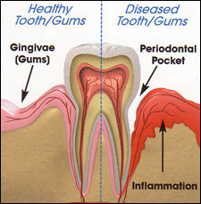 Diagram of healthy and non healthy gums for dentist patients in Milford and Derby
