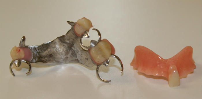 Two types of partial dentures for patients from Derby and Ansonia and West Haven, CT