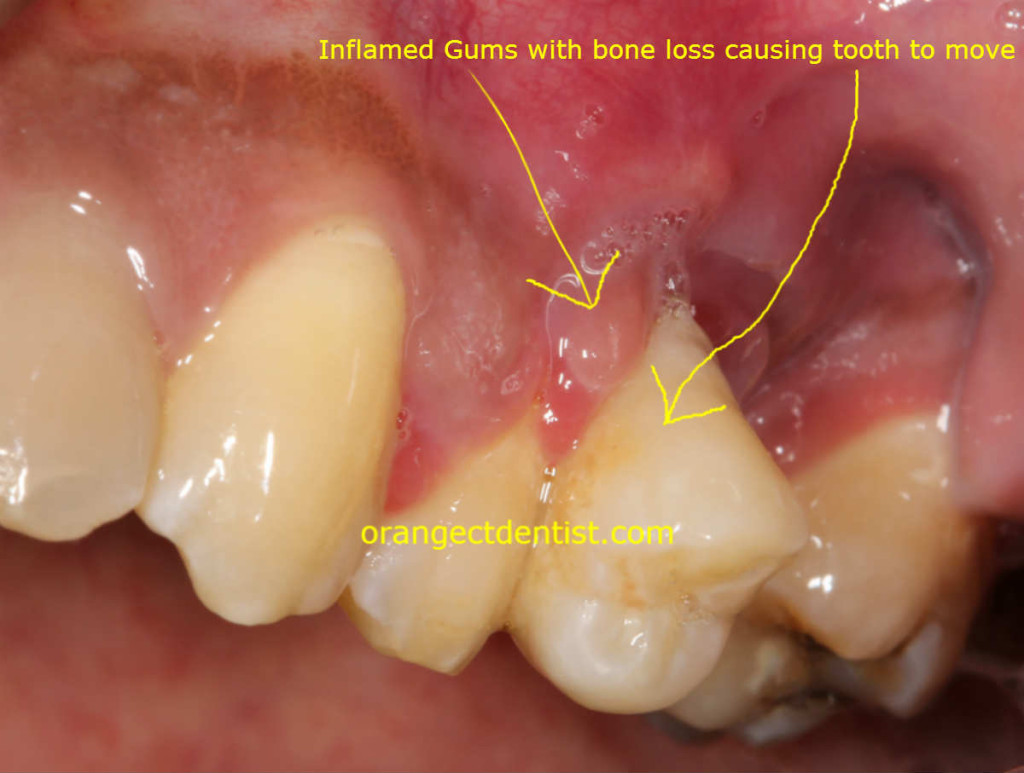 Gum Disease or Periodontitis bleeding gums tooth loss for patient from Milford, CT but also Bridgeport