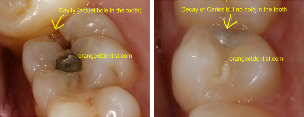 Photo of tooth cavity and dental decay on teeth which both need fillings