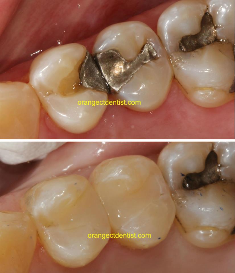 Silvery Mercury Amalgam Filling Removal and Replacement Photos in Orange, CT and Woodbridge, Milford, New Haven, CT
