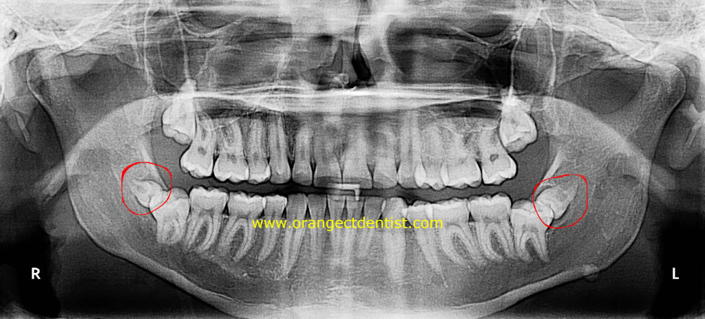 X-ray of supernumerary lower wisdom teeth on panoramic dental x-ray.