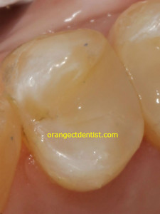 Photo of white or tooth colored filing done in our dentist office serving New Haven, CT area