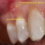 Dental emergency of an abscess for West Haven CT or Woodbridge CT