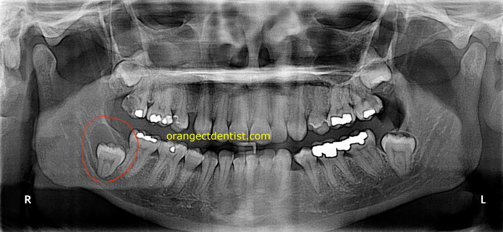 Panoramic x-ray of dentigerous or follicular cyst with an impacted wisdom tooth or third molar