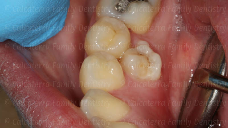 amazing quality photo of extra supernumerary premolar tooth