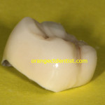 Dental emergency of a dislodged crown of a patient from Milford, CT