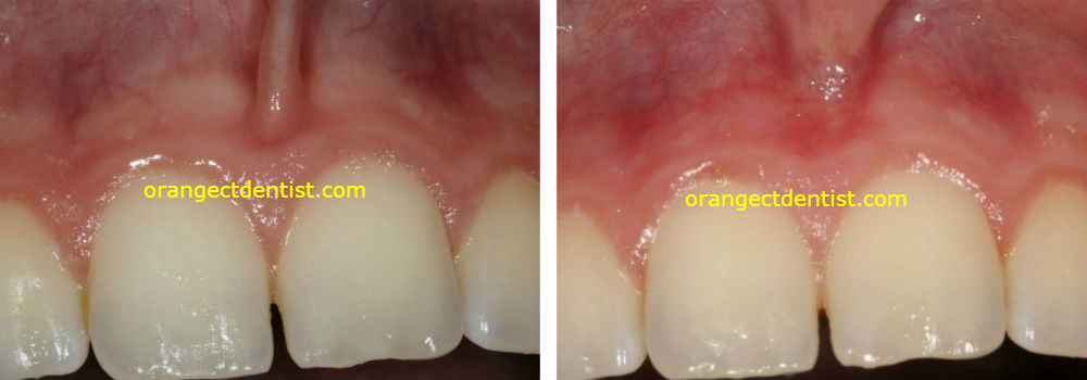 Photos showing how our dental laser helped us perform a painless frenectomy
