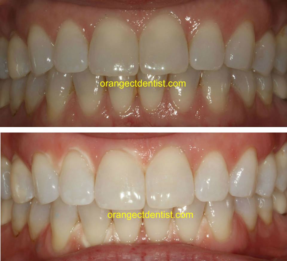 Teeth whitening photos before and after of bleaching for Orange, Milford, and Woodbridge, CT