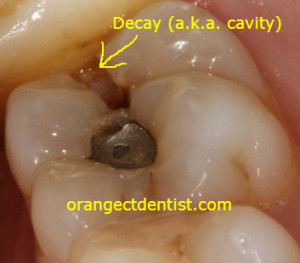 Photo of tooth with dental decay on pregnant patient Woodbridge, CT