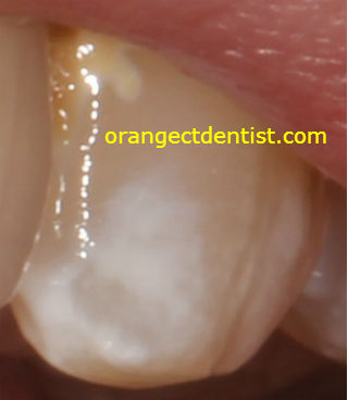 Photo and Picture of Tooth with enamel defect due to celiac disease