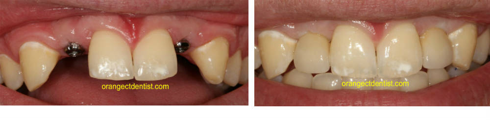Dental Implant photos before and after Orange and West Haven, CT dentist