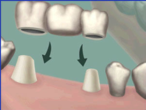 Dental Bridge uses adjacent teeth for support and is used to replace missing teeth for Orange and Woodbridge patients