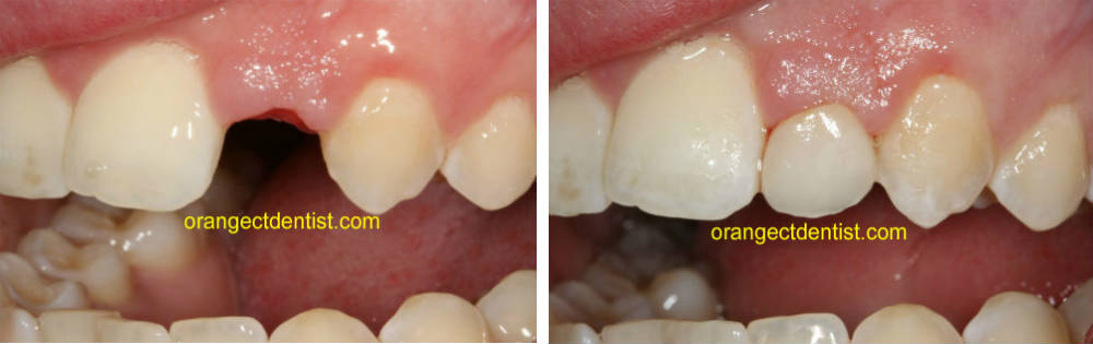 Before and after photo of dental bridge for missing teeth in Milford and West Haven CT