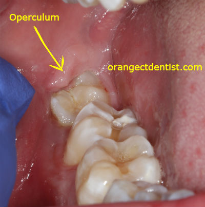 Photo of Operculum over a wisdom tooth from a dental patient from West Haven, CT