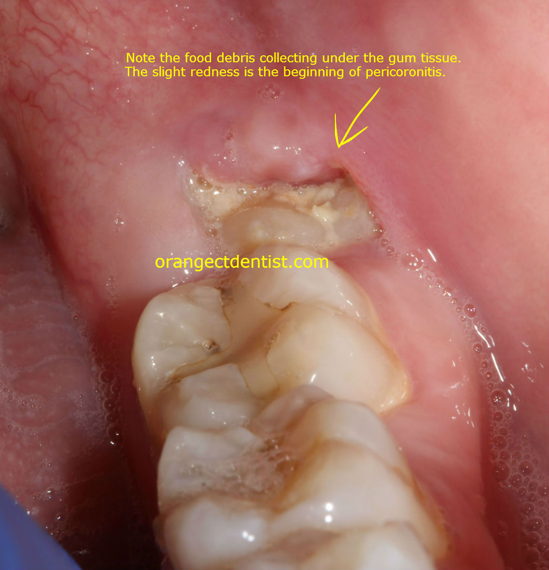 Pericoronitis photo showing infection with a wisdom tooth seen in our office in Orange, CT