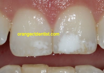 Photo of white spots on teeth that we treat conservatively in our Orange and West Haven CT dentist office