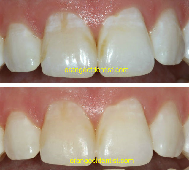 Before and after photos of MI paste to treat white spots on teeth after braces by dentist in Orange and Woodbridge, CT