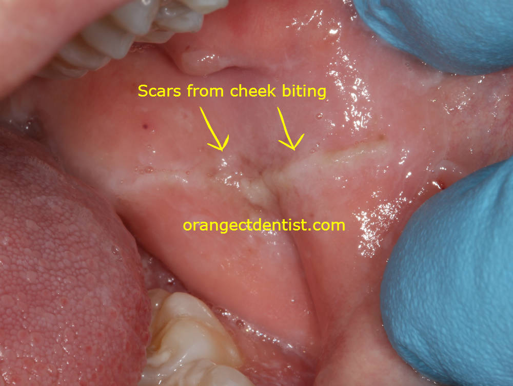 Photo of Cheek biting trauma called linea alba seen by the dentist on the inside of the cheel