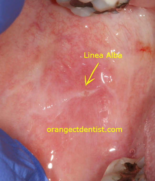 Linea alba from cheek biting seen for dentist for Milford and Derby and West Haven