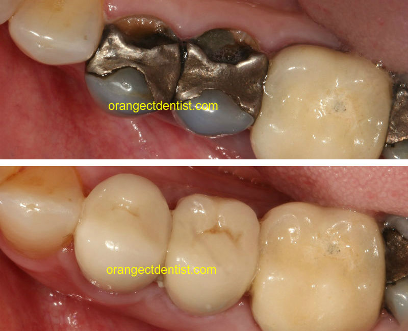 Before and after photo of all ceramic crowns on teeth with dark silvery fillings