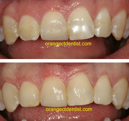 Dental bonding before and after photo in Orange and Woodbridge, CT