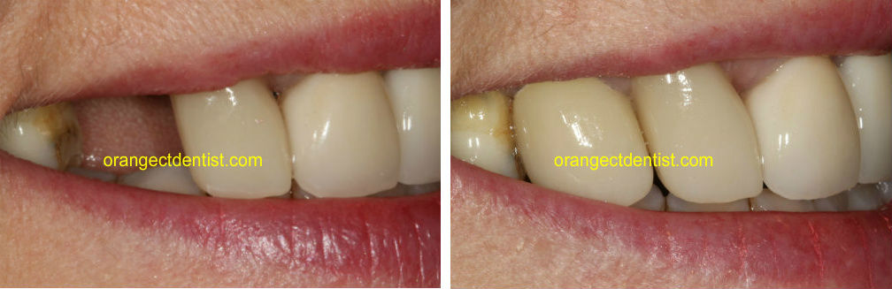 Dental Implant before and after photo showing a toothless smile and then one with a tooth