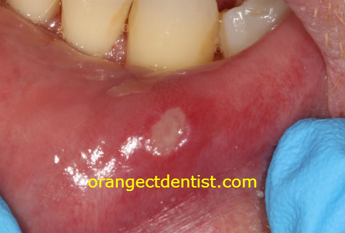 Photograph of a canker sore in Orange, CT dentist office