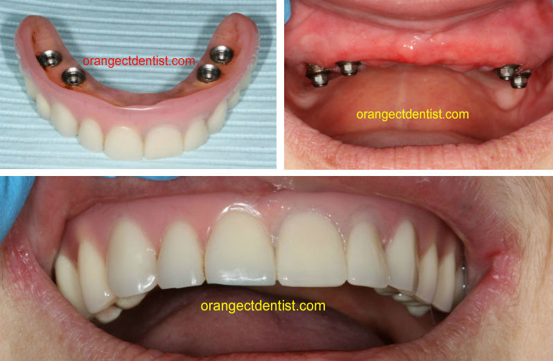 Photo and Picture of implant supported upper denture done in our Orange, CT practice in New Haven County