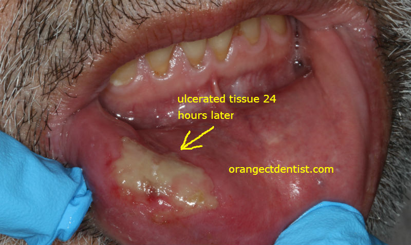 Photo of Lip Biting patient who bit his lip while numb after dentist
