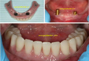 Lower implant overdenture photo from our Orange, CT dentist office where no more adhesive is needed